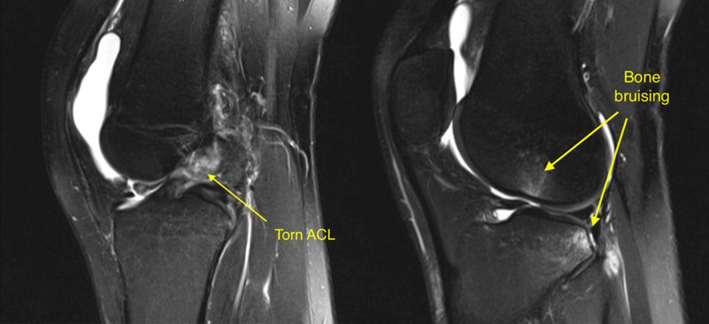 Dr Graeme Brown ACL Tears Treatment