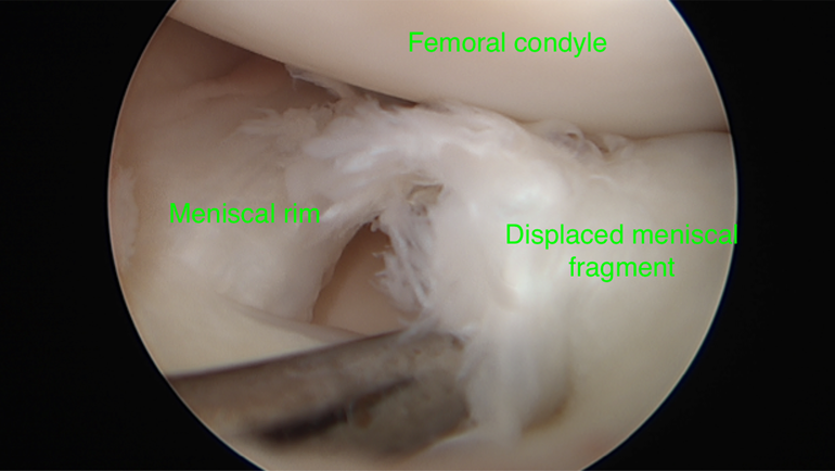 Dr. Graeme Brown - MENISCAL INJURIES TREATMENT