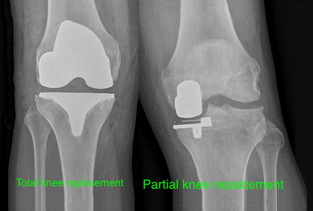 Dr Graeme Brown - Knee Arthritis Treatment