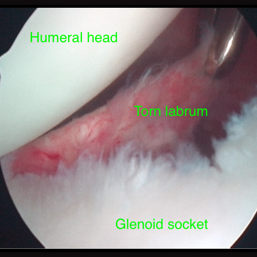 Shoulder Instability