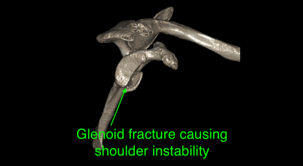 Dr Graeme Brown - Glenoid Fracture Shoulder Instability