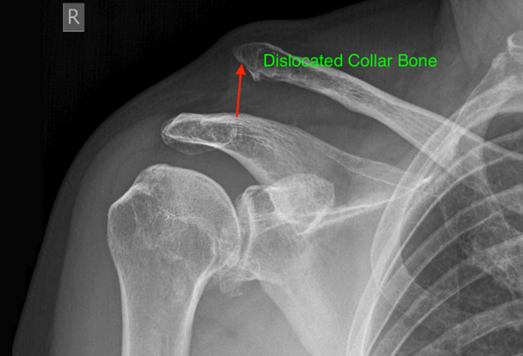 Dislocated Collar Bone