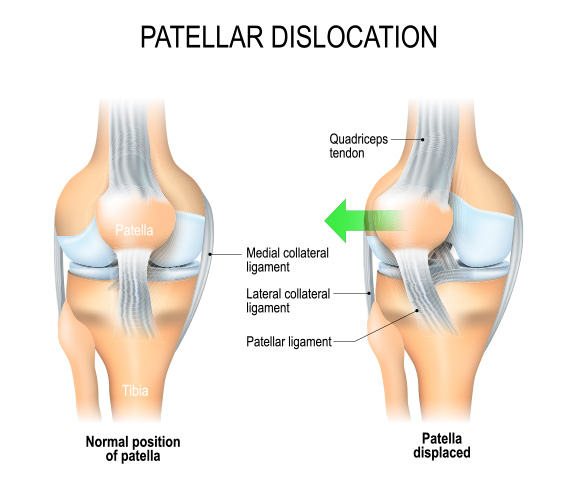 Dr Graeme Brown - Patellar Dislocation