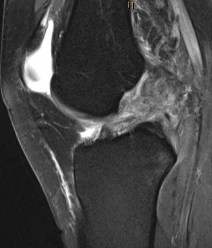 ACL reconstruction in high risk patients