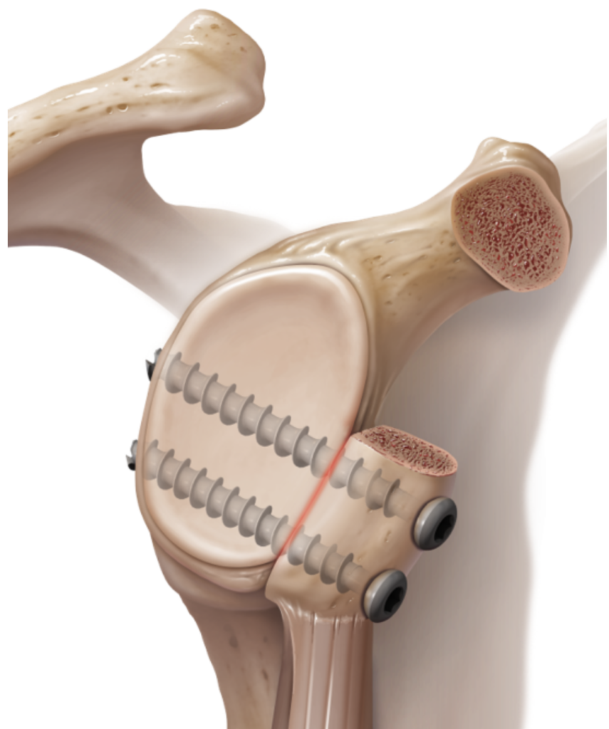 Shoulder Instability: Arthroscopy v Laterjet - Dr Graeme Brown