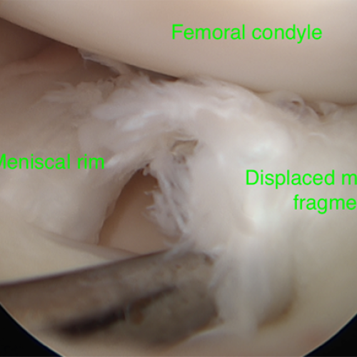 Dr. Graeme Brown - MENISCAL INJURIES TREATMENT