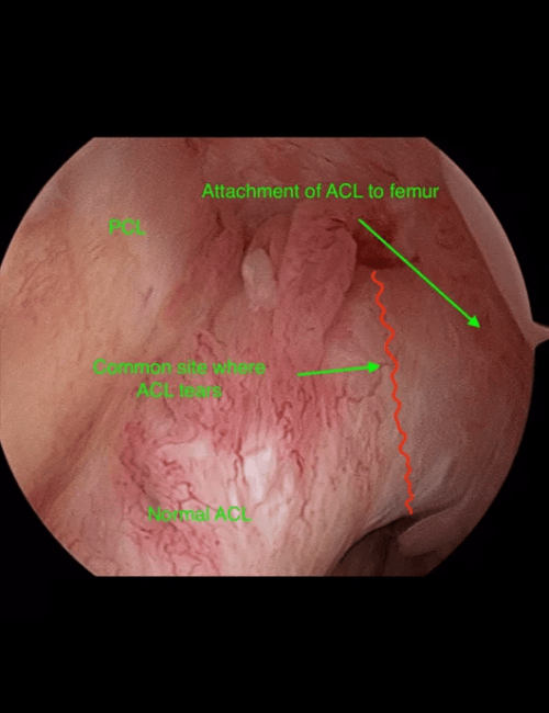 intact-acl-image