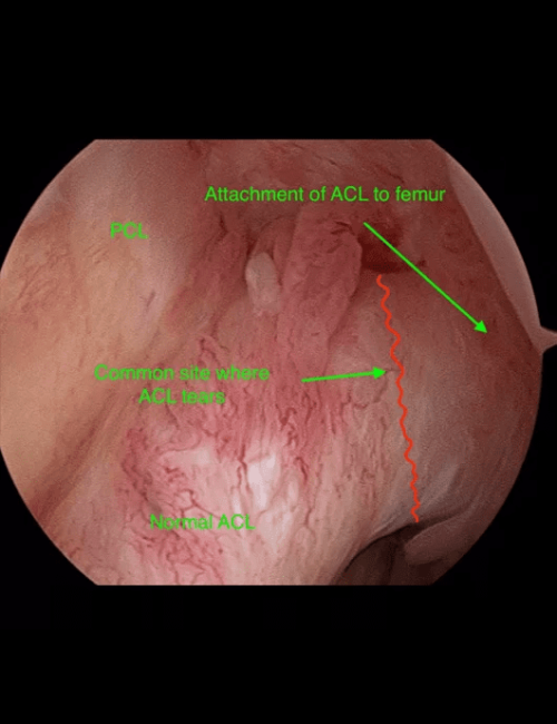 ACL Tears - Dr Graeme Brown